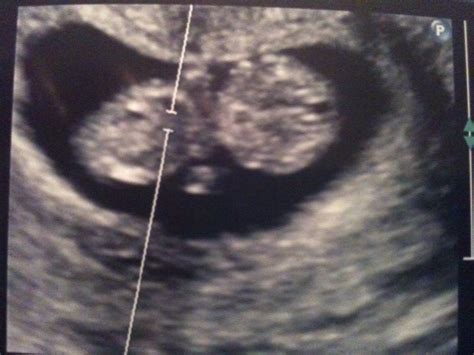 Bumpy Road to Motherhood: Pics of 10 Week Ultrasound