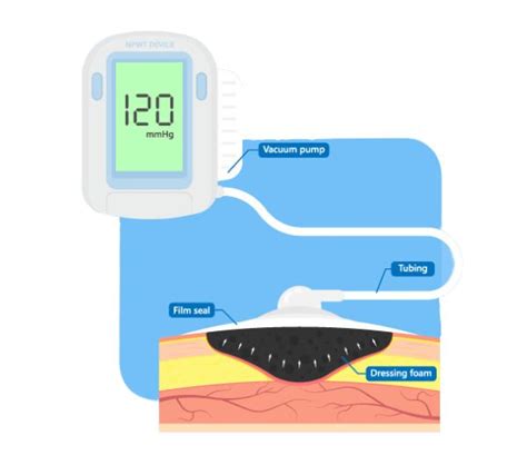 Negative Pressure Wound Therapy Advanced Wound Care