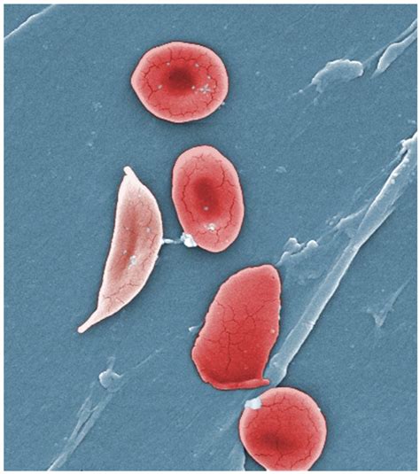 Anemia Sickle Cell Hemoglobin S Disease