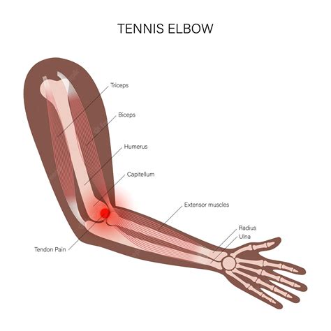 Premium Vector Lateral Epicondylitis Tennis Elbow