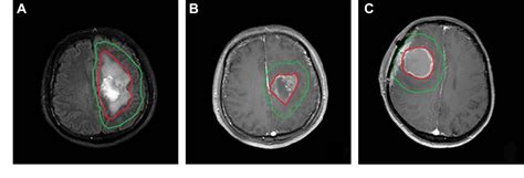 Figure 1 From Delineation Of Radiation Therapy Target Volumes For