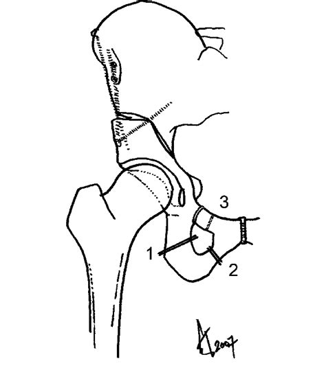 The Approximate Locations Of The 1 Ischial 2 Inferior Ramus And Download Scientific