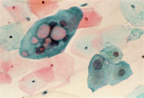 Lm Of Cervical Smear Chlamydia Infection By Science Photo Library