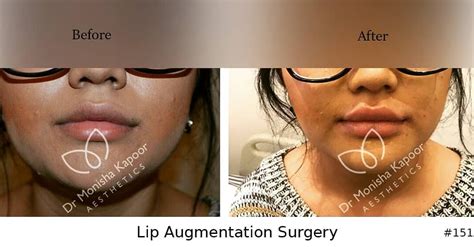 Get The Best Lip Augmentation Surgery In India By Dr Monisha Kapoor