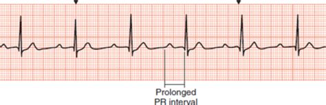 Heart Block Dysrhythmias Flashcards Quizlet