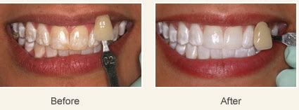 Dental Fluorosis Treatment | Micro Abrasion & Tooth Bleaching | Bangalore