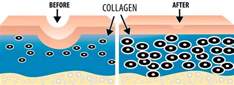 Microneedling For Acne Scars Reducing Acne Scars By Microneedling Jj