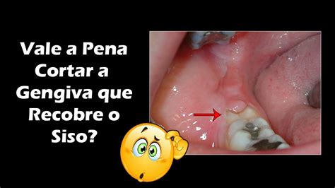 Dente Do Siso Vale Mais A Pena Cortar A Gengiva Ou Fazer A Extra O