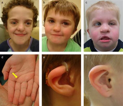 Charge Syndrome A Review Hsu Journal Of Paediatrics And