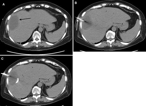 Ct Guided Drainage Of Liver Abscess Transverse Image Through The