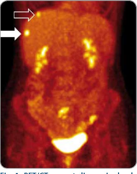 Figure 1 From Durable Complete Response Of Colorectal Cancer Metastasis