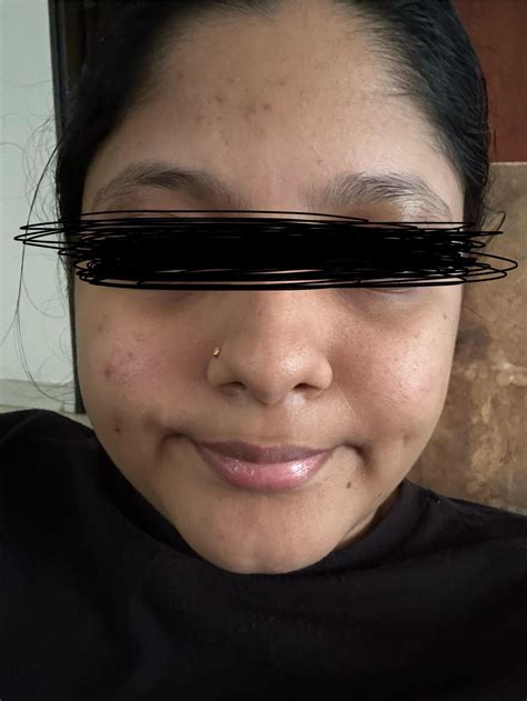 One Month On Tret Rtretinoin