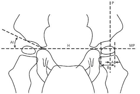 Measurement Of The Migration Percentage Mp And Acetabular Index Ai