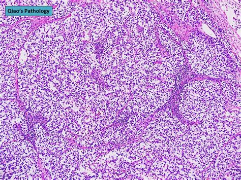 Flickriver Photoset Testicular Pure Seminoma By Qiaos Pathology