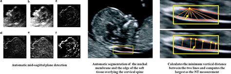 Frontiers Artificial Intelligence In Obstetric Ultrasound An Update And Future Applications