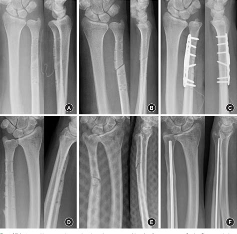 Figure 2 From Comparison Of Ulnar Shortening Osteotomy For Idiopathic