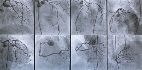 Coronary Angiography Stock Photo Download Image Now Cardiac