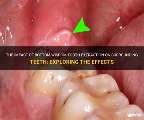 The Impact Of Bottom Wisdom Tooth Extraction On Surrounding Teeth Exploring The Effects Medshun