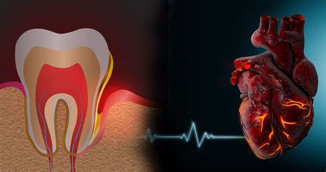 Tooth Decay Cavities Periodontal Disease Cause Heart Disease