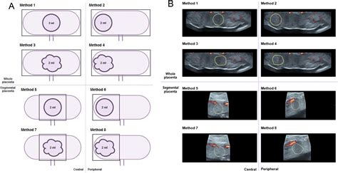 Feasibility Of Three Dimensional Power Doppler Ultrasonography Methods To Assess Placental