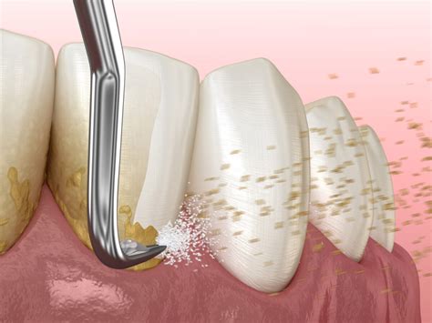 Sterling Smiles Azle What Is Scaling And Root Planing