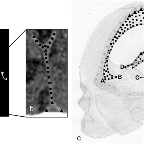 Surface reconstruction from routine CT-scan shows large anatomical variations of falx cerebri ...