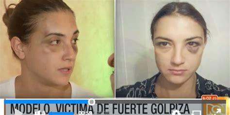 Modelo Es Salvajemente Golpeada Por Su Pareja Un Profesor