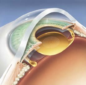 Multifocal Intraocular Lenses - Schulze Vision & Surgery Center