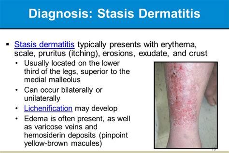 Stasis Dermatitis(Eczema on Legs) Symptoms Causes & Treatment