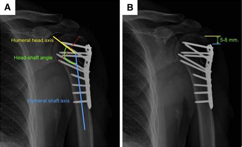 Fluoroscopic Technique For Open Reduction And Internal Fixation Of