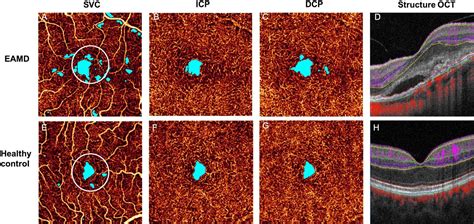 Plexus Specific Retinal Capillary Avascular Area In Exudative Age