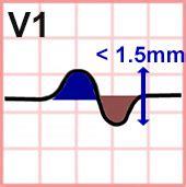 P Wave - ECG book