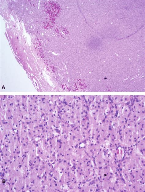 A Mass Is Covered By Thin Stratified Squamous Epithelial Mucosa At Low