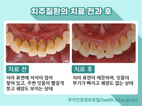 국가건강정보포털 건강정보 7월 ‘치주질환 예방·관리 정책뉴스 뉴스 대한민국 정책브리핑