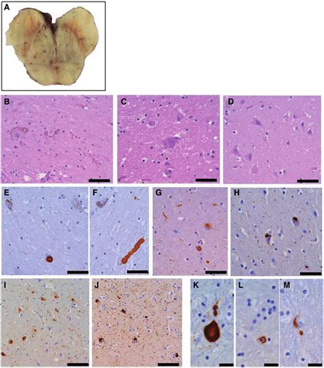 Neuropathological Findings A Macroscopic Imaging Of The Midbrain