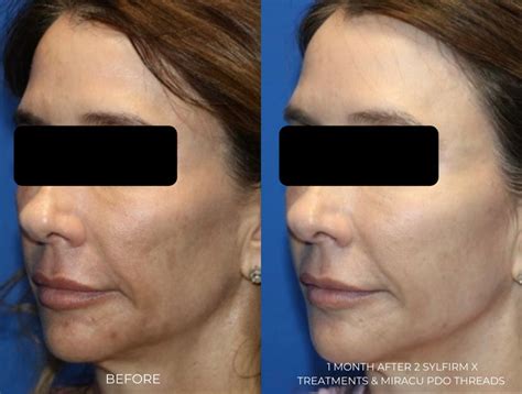 Sylfirm X Rf Microneedling Radiant Health Glendale Az