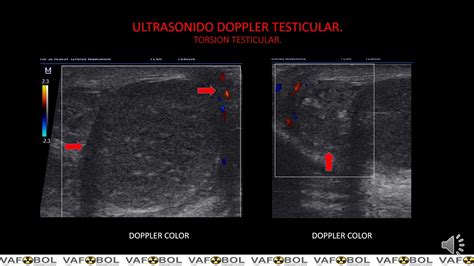 Ecografia Doppler Testicular Torsion Youtube