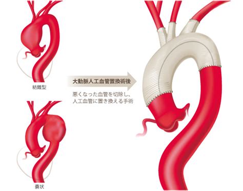 大動脈解離の看護｜分類a型b型や症状、術後の観察項目と看護計画 ナースのヒント