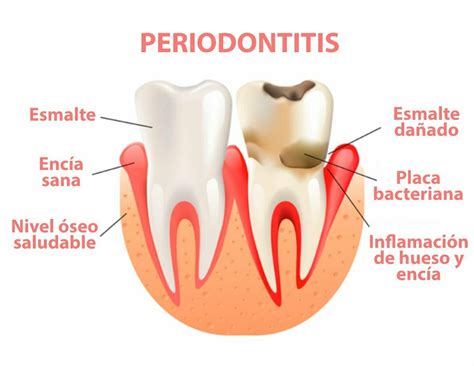 Periodontitis Síntomas causas y tratamiento Clínica dental Provenza