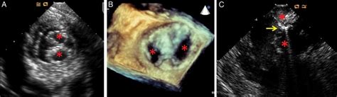 Mitraclip® Implantation A Transgastric Short Axis Two Dimensional Download Scientific