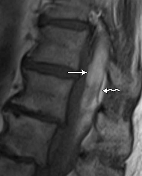 Spinal Hematomas What A Radiologist Needs To Know Radiographics