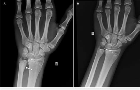 Anteroposterior Radiographs Of The Left A And The Right B