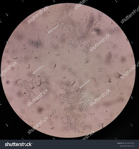 Microscopic Fungi Malassezia Furfur Showing Yeast Stock Photo