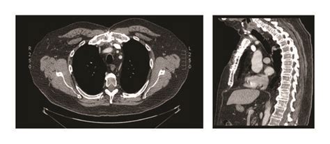 Ct Scan Preoperative Axial And Sagittal Views Of The Tumor White Download Scientific Diagram