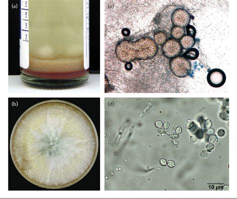 Figure 1 From Neosartorya Hiratsukae Peritonitis Through Continuous