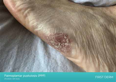 Itchy Bumps On The Side Of My Foot Online Emergencydentistry