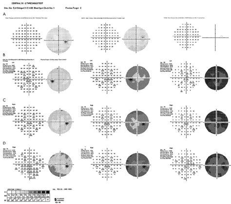 A Central Static Threshold Perimetry To Light And Dark Adapted