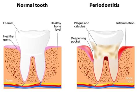 Prevention Of Periodontitis