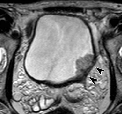 Urinary Bladder Cancer Diffusion Weighted Mr Imaging—accuracy For