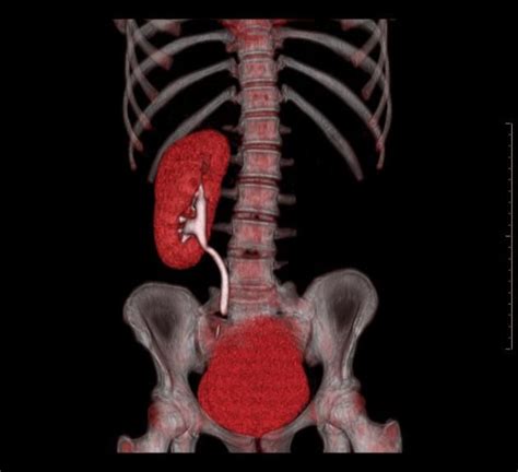 Renal agenesis | Radiology Case | Radiopaedia.org | Renal, Radiology, Kidney transplant